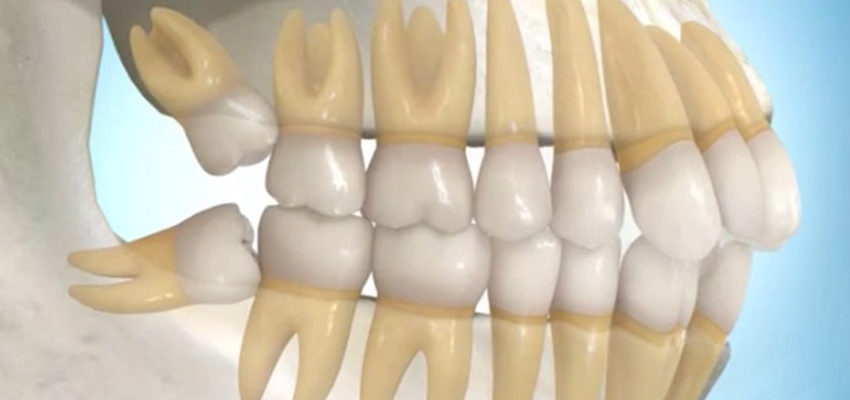 pain during wisdom tooth eruption