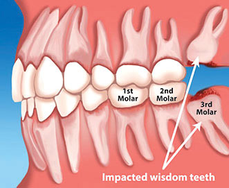 wisdom teeth age 42